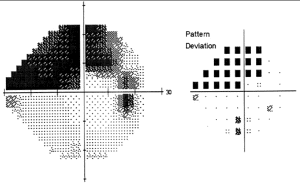 OPEN GLAUCOMA